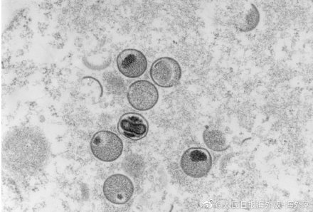 英国已有超1700例猴痘确诊病例 多个组织批国内疫苗接种缓慢