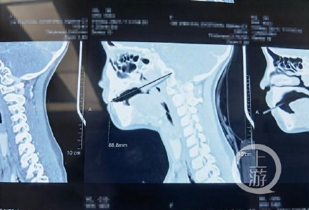 心疼！女童边吃雪糕边玩滑板车，摔跤后雪糕棍刺穿了咽喉